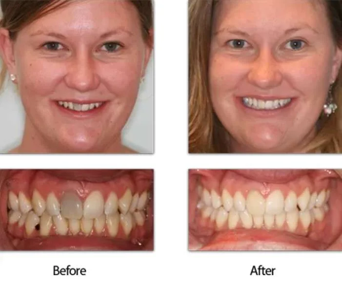 Root Canal Before and After